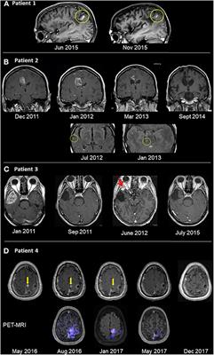 Effective Treatment of Glioblastoma Multiforme With Oncolytic Virotherapy: A Case-Series